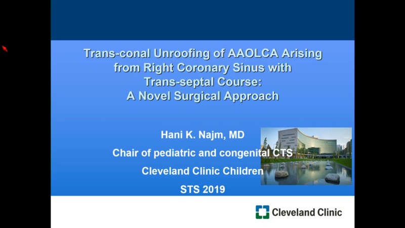 Transconal Unroofing of a Septal Course of Anomalous Aortic Origin of a ...