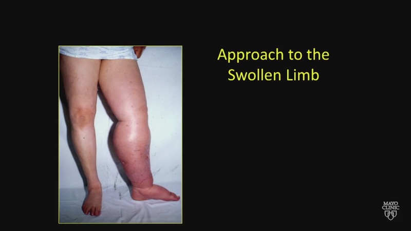 Differential Diagnosis of Limb Swelling