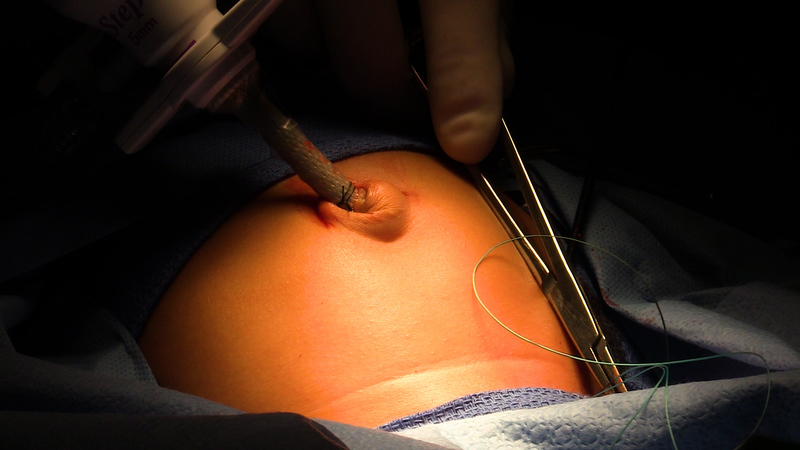 Laparoscopic inguinal hernia repair (TEP)