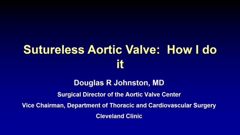 Sutureless Aortic Valve Replacement